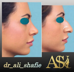 نمونه کار جراحی بینی - دکتر علی شفیعی
