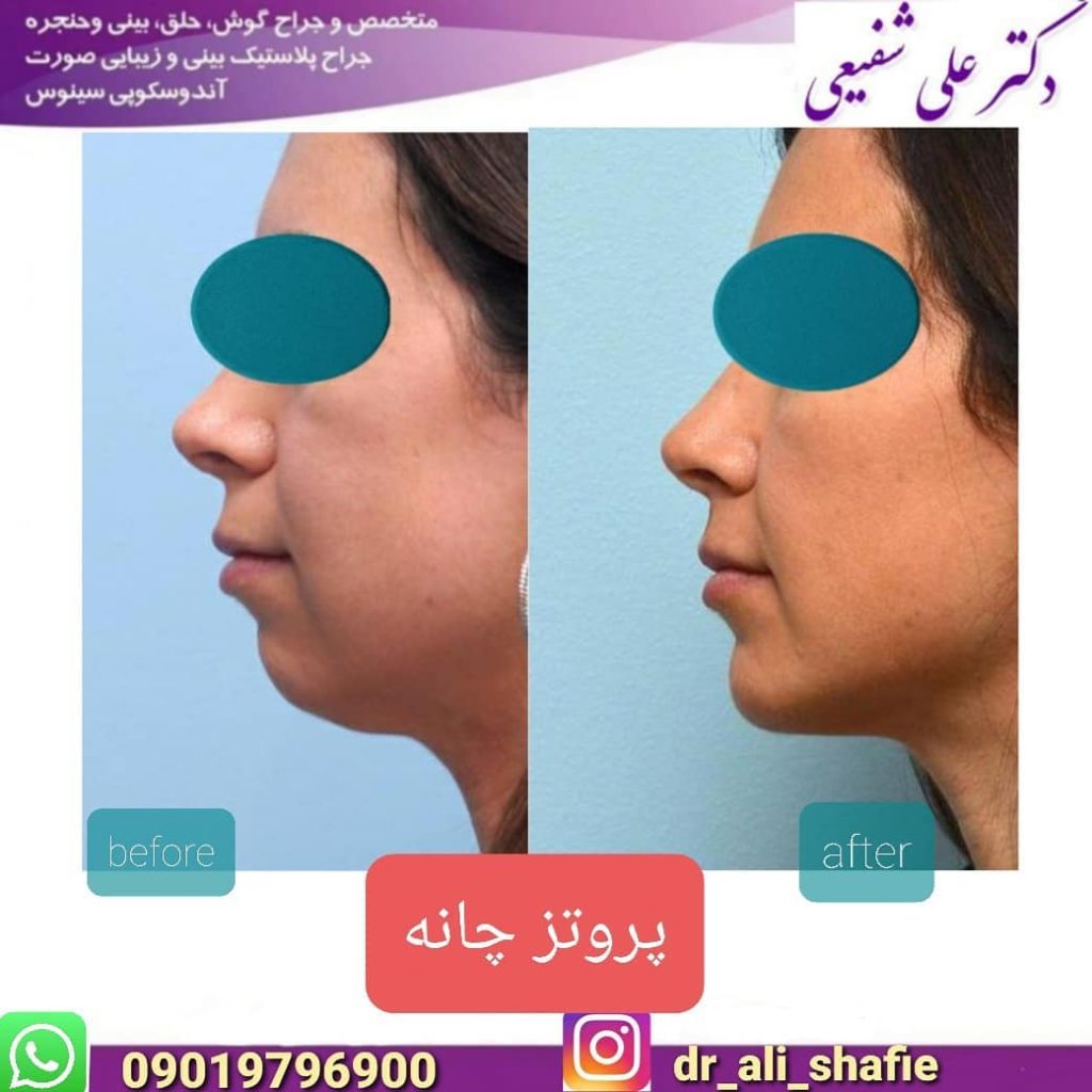 پروتز چانه