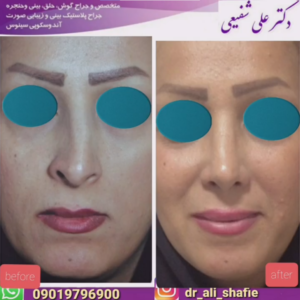جراحی بینی کج - دکتر علی شفیعی
