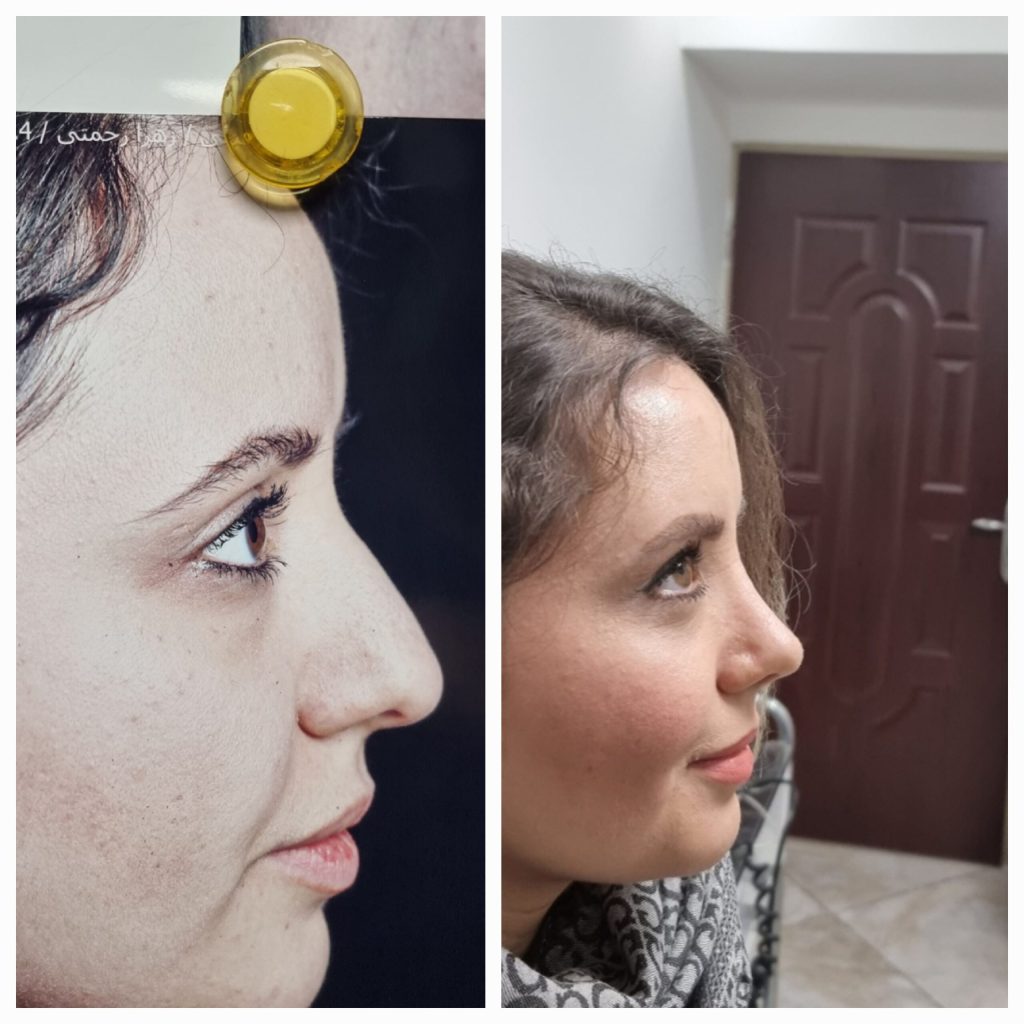 جراحی بینی فانتزی کرج