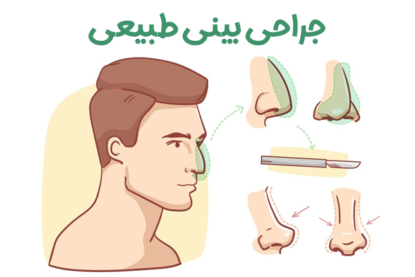جراحی بینی طبیعی - دکتر علی شفیعی 