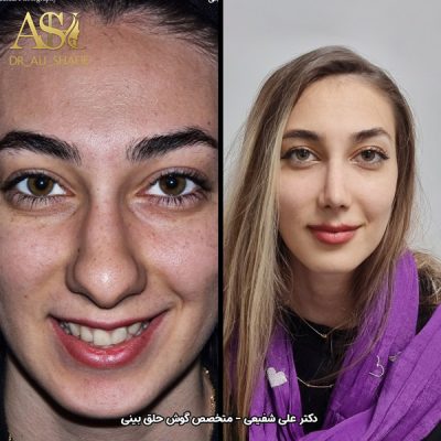 جراحی بینی در تهران - دکتر علی شفیعی