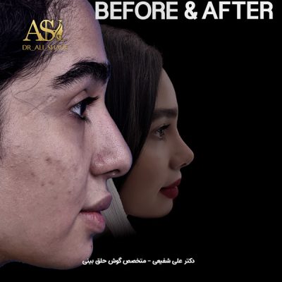 جراحی بینی در تهران - دکتر علی شفیعی
