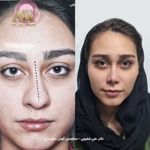 بهترین جراح بینی تهران - دکتر علی شفیعی
