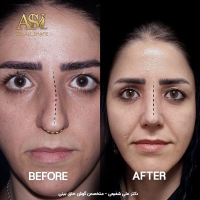 جراحی بینی - دکتر علی شفیعی