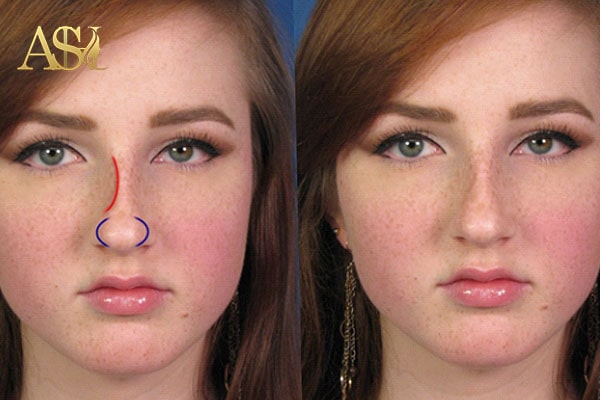 اهمیت نوع پوست در جراحی بینی