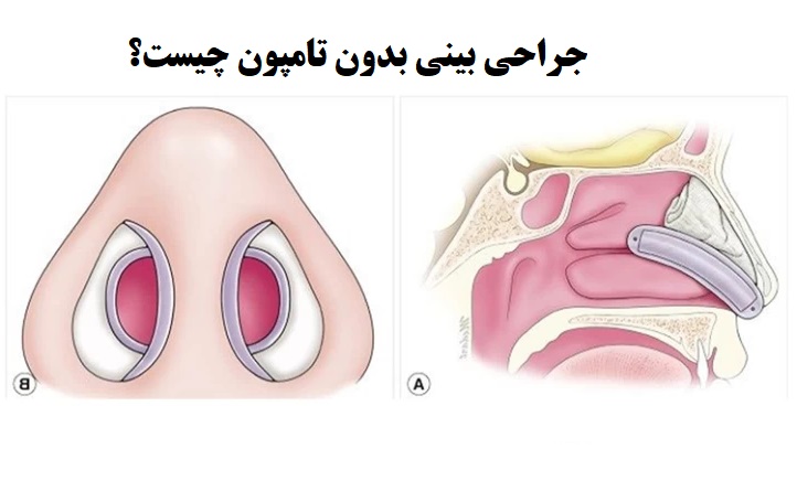 جراحی بینی بدون تامپون چیست؟