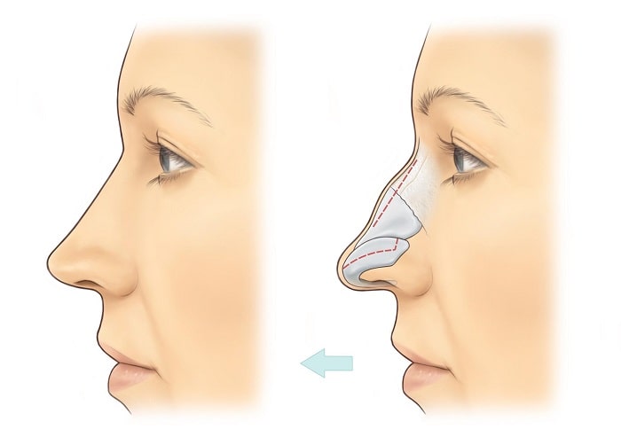 پیوند غضروف بینی در جراحی زیبایی 