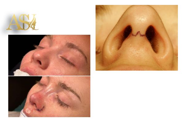 بخیه‌ بینی چیست و چرا استفاده می‌شود؟