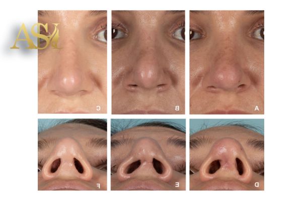 بینی بعد عمل