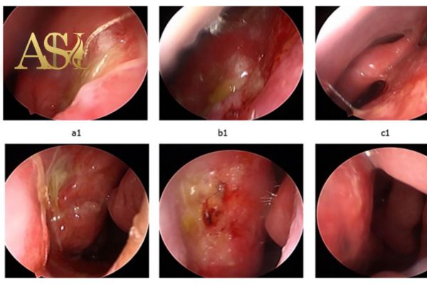 تاثیر عفونت بینی بعد عمل بر روی نتیجه جراحی