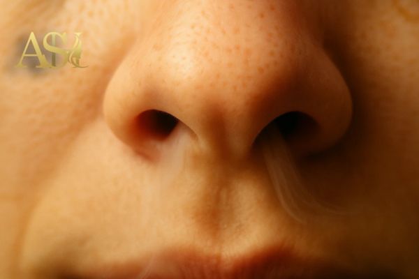 افتادگی نوک بینی بعد از عمل و دلایلش 