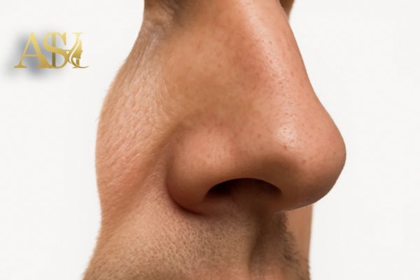 افتادگی نوک بینی