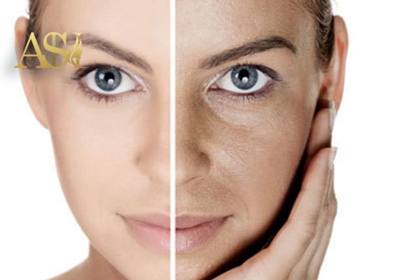 PRP صورت چیست و چگونه انجام میشود؟