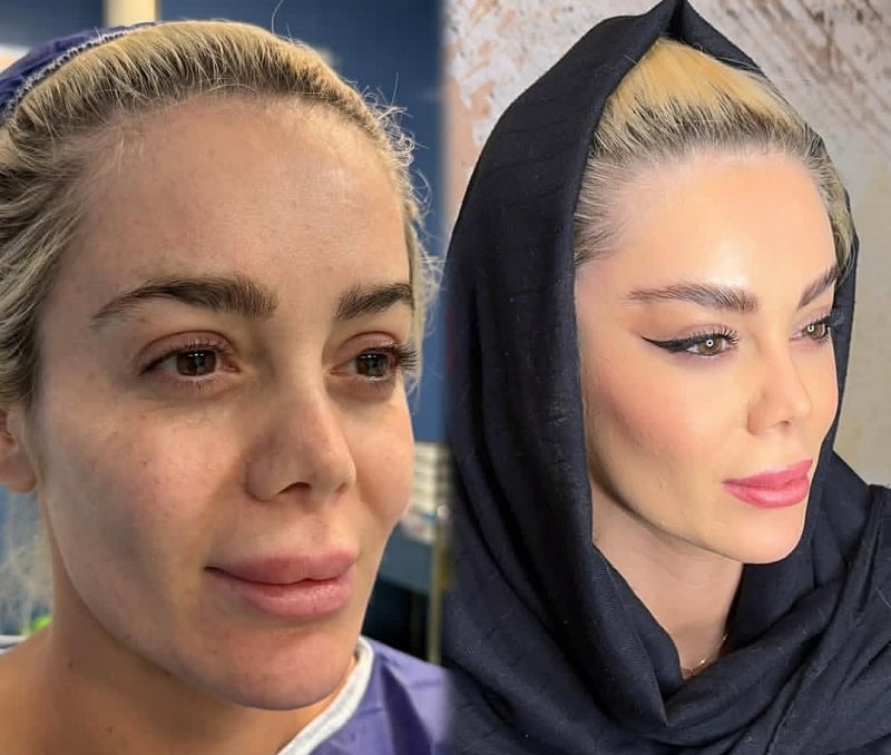 قبل و بعد لیفت در کرج