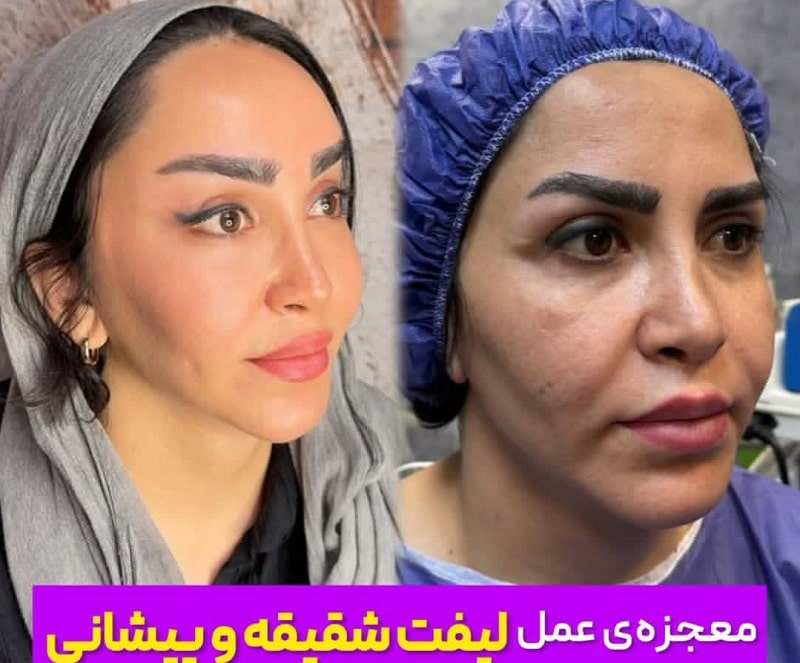 جراحی لیفت شقیقه در کرج