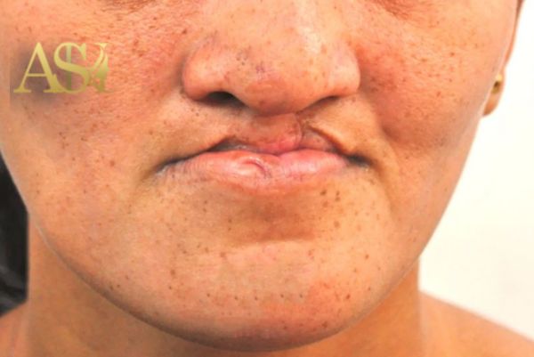 عمل بینی افراد لب شکری