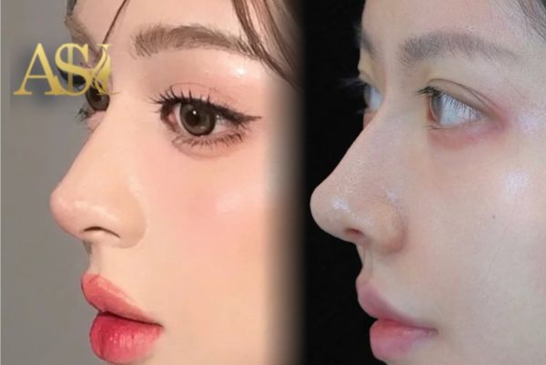 ترند بینی طبیعی و قوز بینی ۲۰۲۶