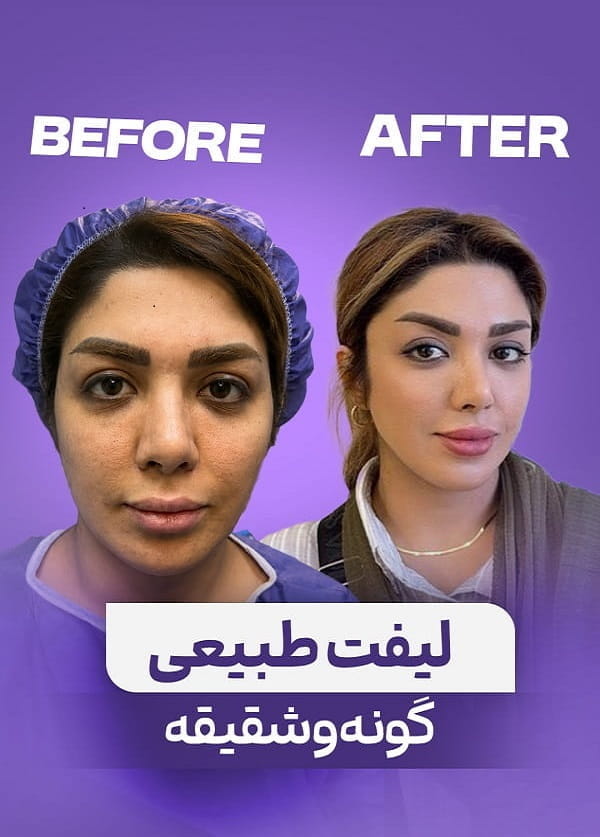 لیفت اندوسکوپیک شقیقه