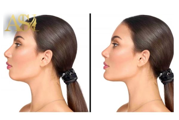 تاثیر جراحی پروتز چانه بر زاویه دار شدن صورت