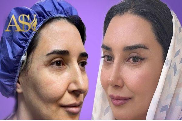 7 سوال مهمی که قبل از لیفت شقیقه باید از جراح بپرسید.
