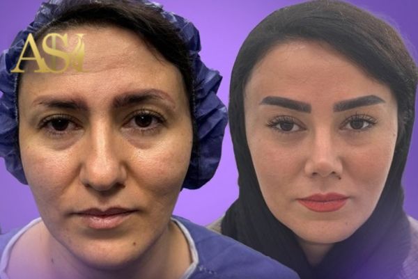آیا کاهش یا افزایش وزن روی نتیجه لیفت صورت تاثیر دارد؟