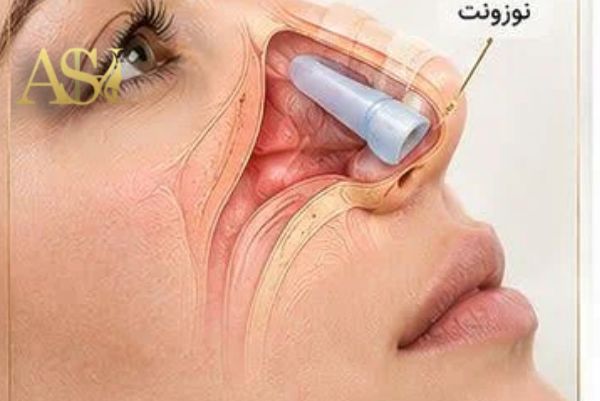 نوزونت چیست؟
