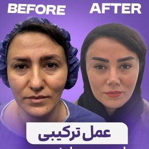 عمل-ترکیبی-بینی-لیفت-صورت