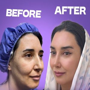 عمل همزمان بینی لیفت